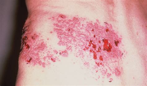 Herpes zoster infection 